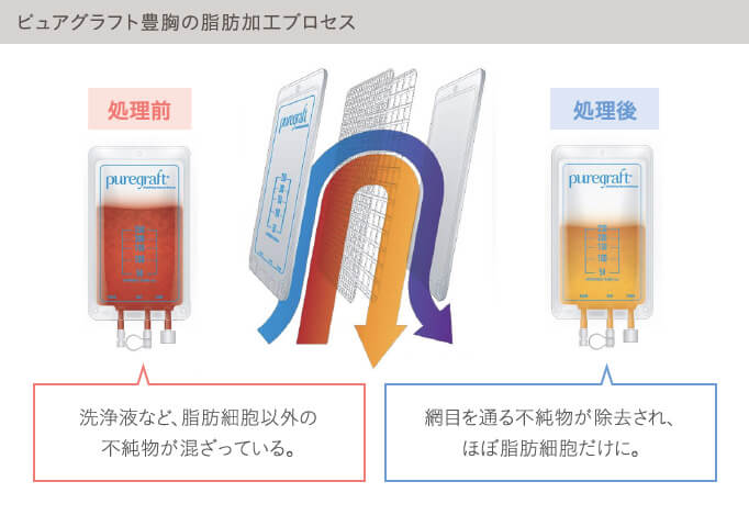 ピュアグラフト豊胸とは