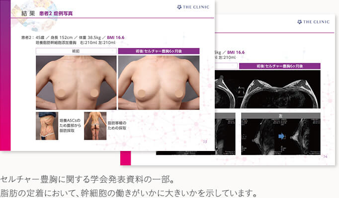 最新の脂肪注入豊胸「セルチャー豊胸」の症例