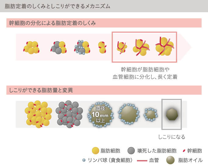脂肪注入豊胸のしこりの正体