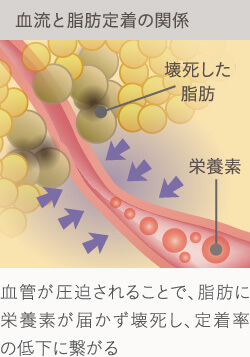 脂肪注入豊胸後、定着を悪くするのが血管の圧迫